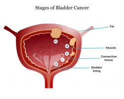 Stages-of-Bladder-Cancer